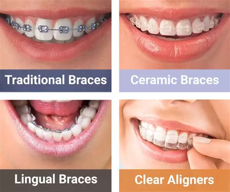 types of metal dental brackets|can braces damage your teeth.